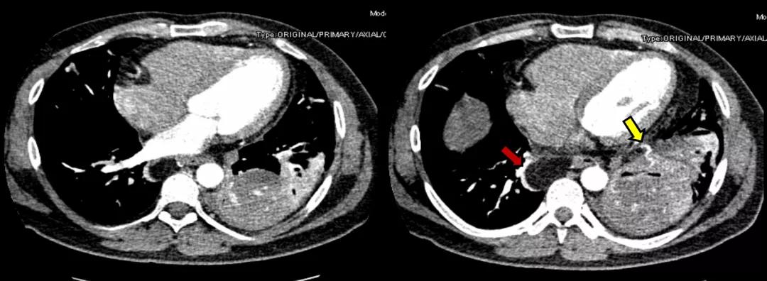 咳嗽10多天了有白痰细菌感染,咳嗽是肺部真菌感染吗
