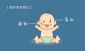 湿疹结痂怎么处理,破皮湿疹