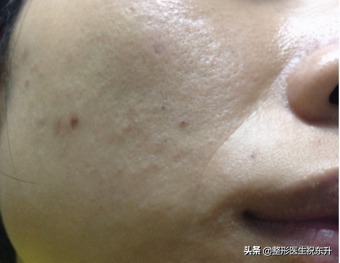 去法令纹最有效的办法亲测,去除法令纹最佳方法费用