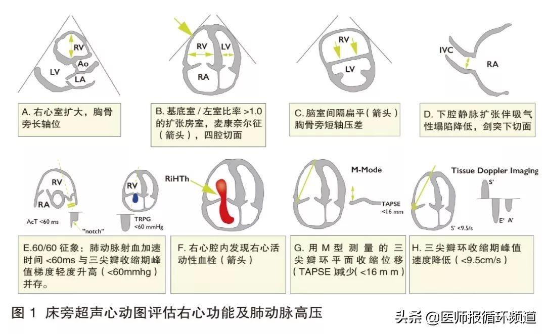 围手术期急性肺栓塞防治指南,肺栓塞诊治指南2018ppt