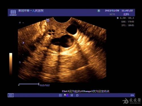 未婚宫颈囊肿影响怀孕吗,未婚宫颈多发囊肿什么意思严重吗