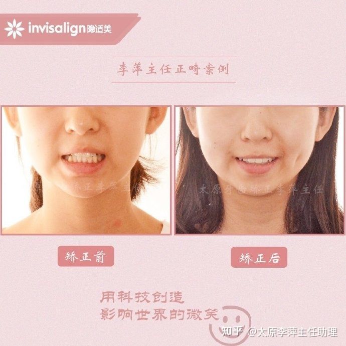 太原牙齿矫正靠谱吗,太原成人隐形牙套牙齿不齐