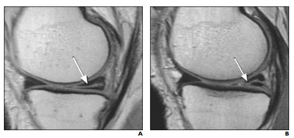 骨科半月板损伤怎么治疗最好,骨科医院半月板