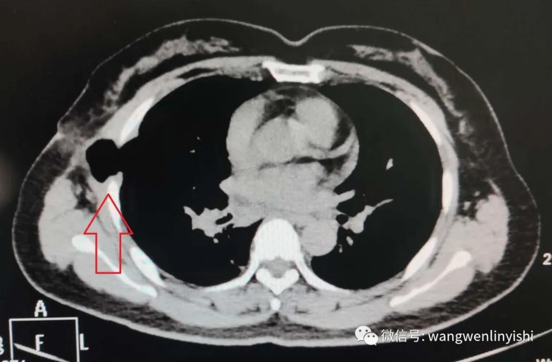 腹腔镜下腹股沟疝修补术切口等级,腔镜下腹膜外疝修补术流程