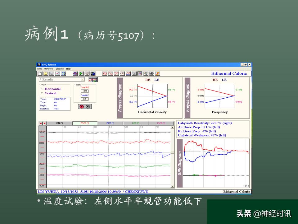 良性位置性眩晕诊断和治疗指南,良性阵发性位置性眩晕的诊断标准