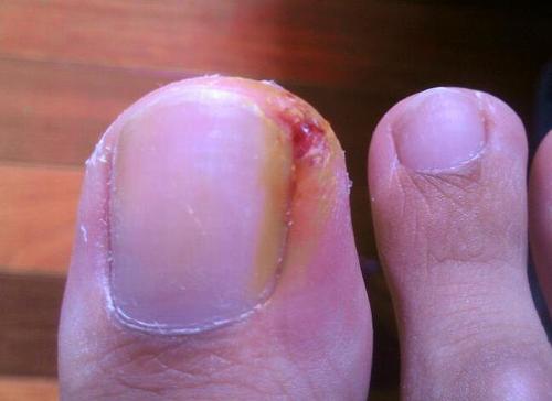 甲沟炎拔过指甲后怎么预防,脚趾盖掉了如何预防甲沟炎