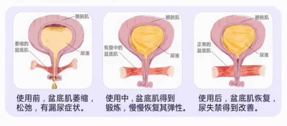 盆底肌锻炼“神器”，众多明星的推荐