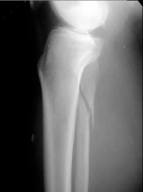 特殊骨折类型,特殊骨折体征