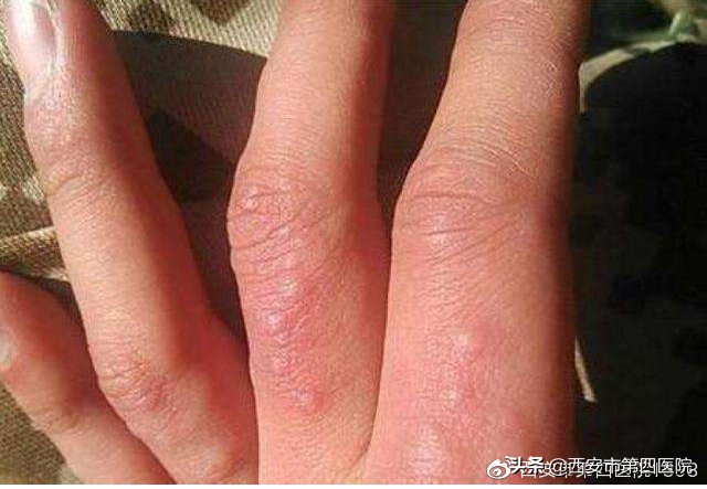 为什么一到夏天手上会长小水泡,夏天手脚长小水泡用什么药