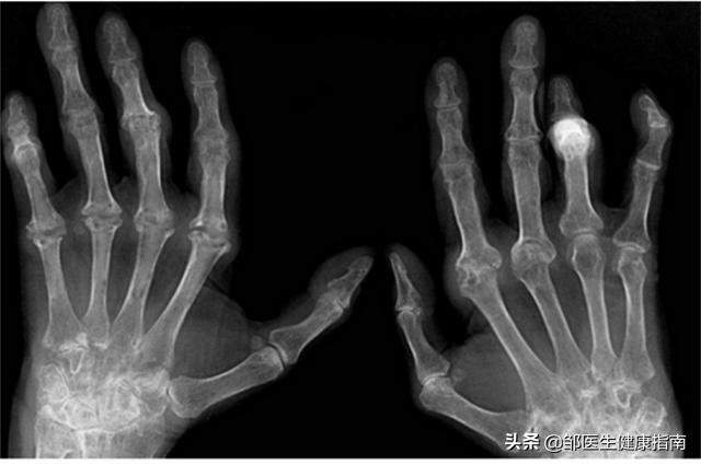 手指关节有结节是什么病,手指结节的地方疼痛是什么病