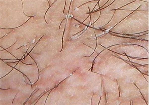 毛发稀疏可能是什么原因,毛发稀疏