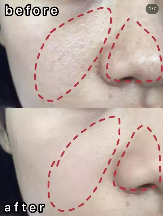 姘ㄥ熀閰稿噣閫忕編鐧芥磥闈钩鐩存挱,姘ㄥ熀閰告场娌礂闈㈠ザ缇庣櫧鐩存挱