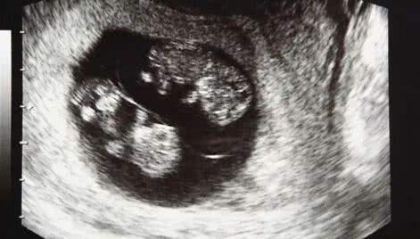 怀孕30周突然胎停是什么原因,怀孕突然停胎孕妇有什么反应