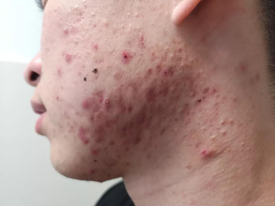 皮肤科医生最喜欢的痘痘
