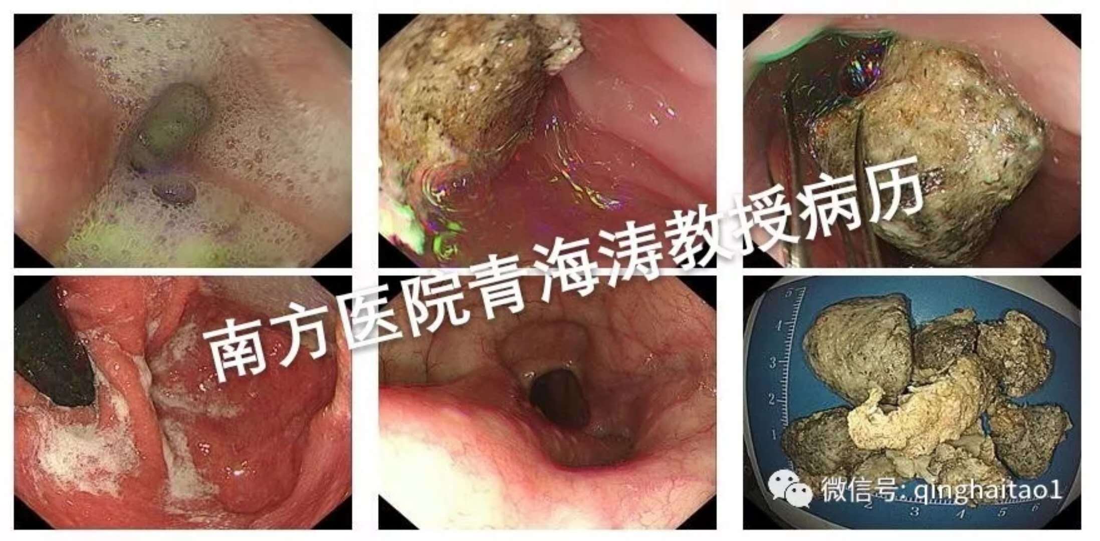 宝宝贲门失弛缓症症状,贲门失弛缓症微创手术