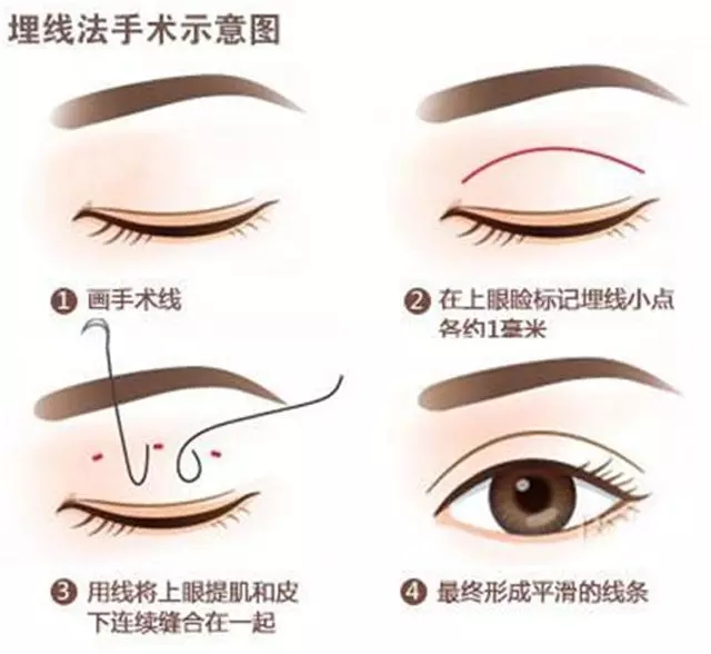 埋线双眼皮术后效果,双眼皮埋线术后消肿日记