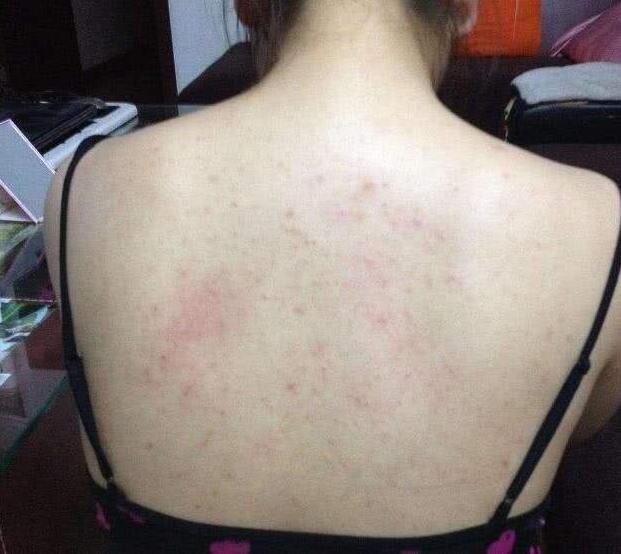 后背痘痘好了但是留有黑色印,后背很多痘痘和痘印怎么办