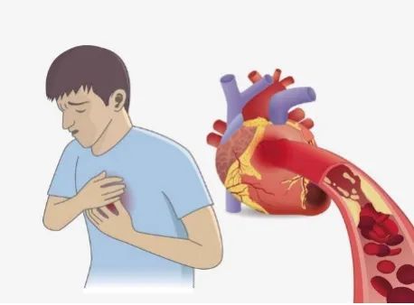 没有征兆而突发心梗有多可怕,哪些地方疼会是心梗的前兆