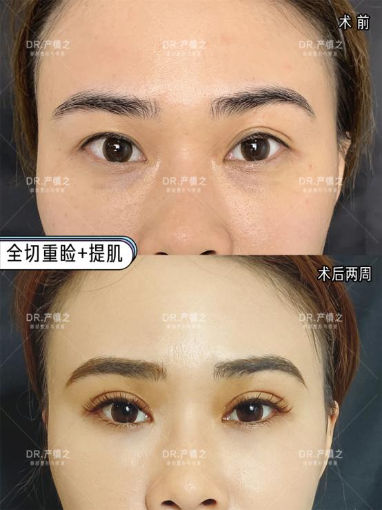 没有内眦赘皮可以开内眼角么,有内眦赘皮不开眼角只割双眼皮