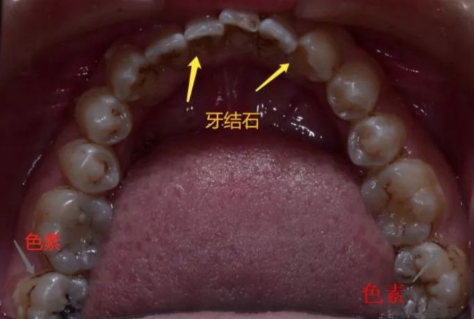 洗牙后牙缝变大了能自然恢复吗,为什么洗牙会让牙缝变大