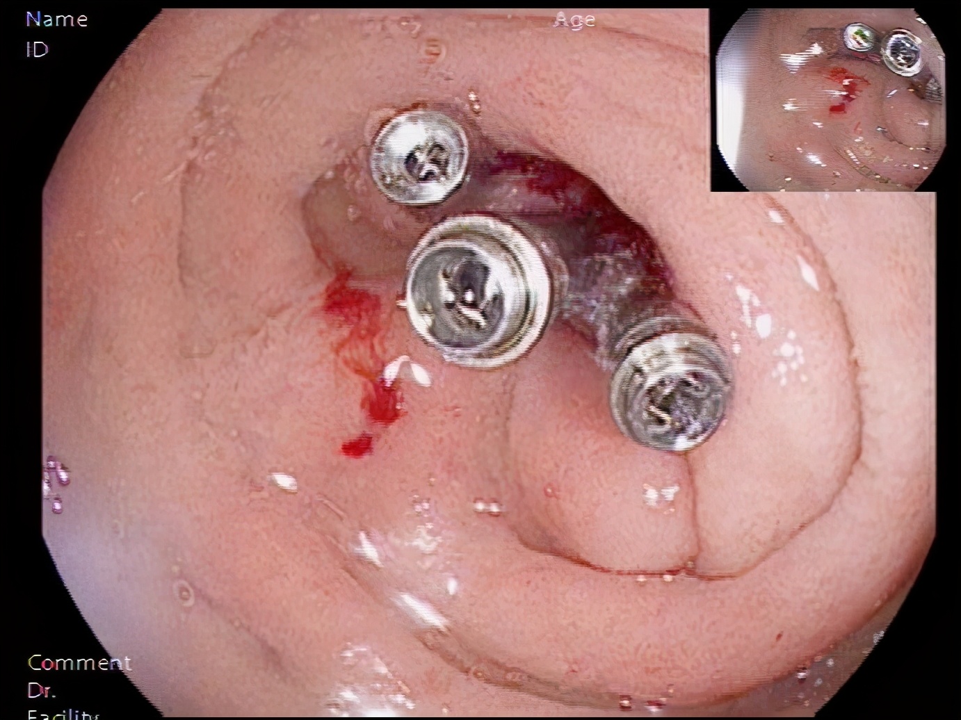 急性上消化道出血急诊诊治流程,上消化道出血快速救治通道