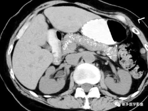 腹部平片能看到结石吗,腹部高密度结节影是什么
