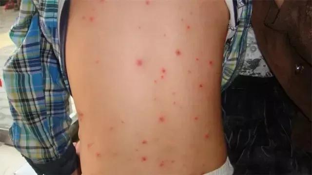 水痘防控知识,健康提示水痘高发准备战痘