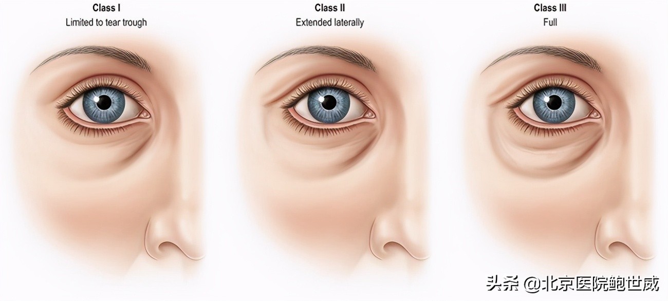 泪沟严重显老怎么办,泪沟显老的地方