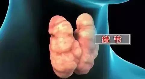 关注甲状腺疾病的专家,广东省甲状腺疾病著名专家