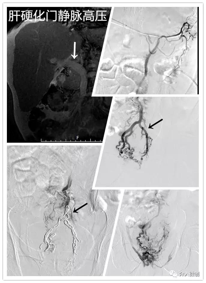 肝硬化引起痔疮便血,肝硬化病人为什么会出现便血症状