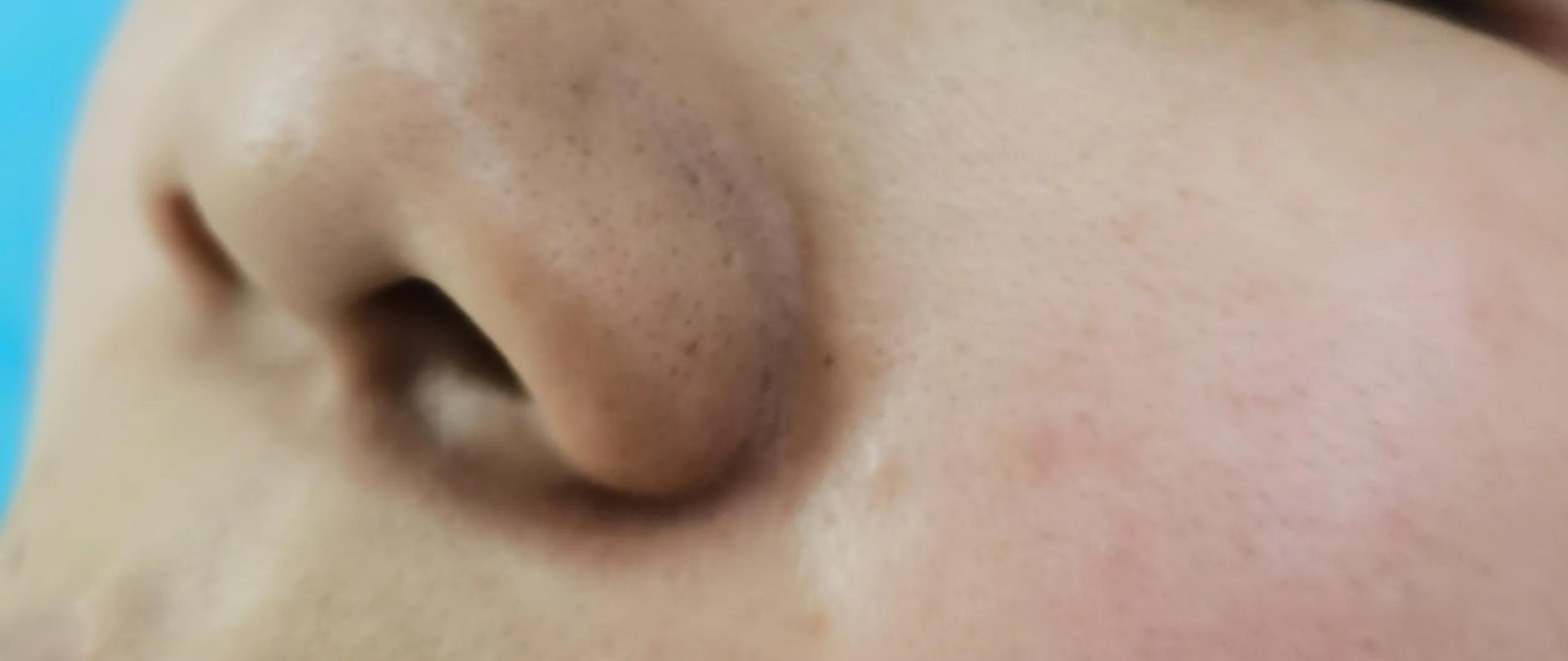 整形医生做面部美容视频,鼻头鼻翼缩小术的真实案例