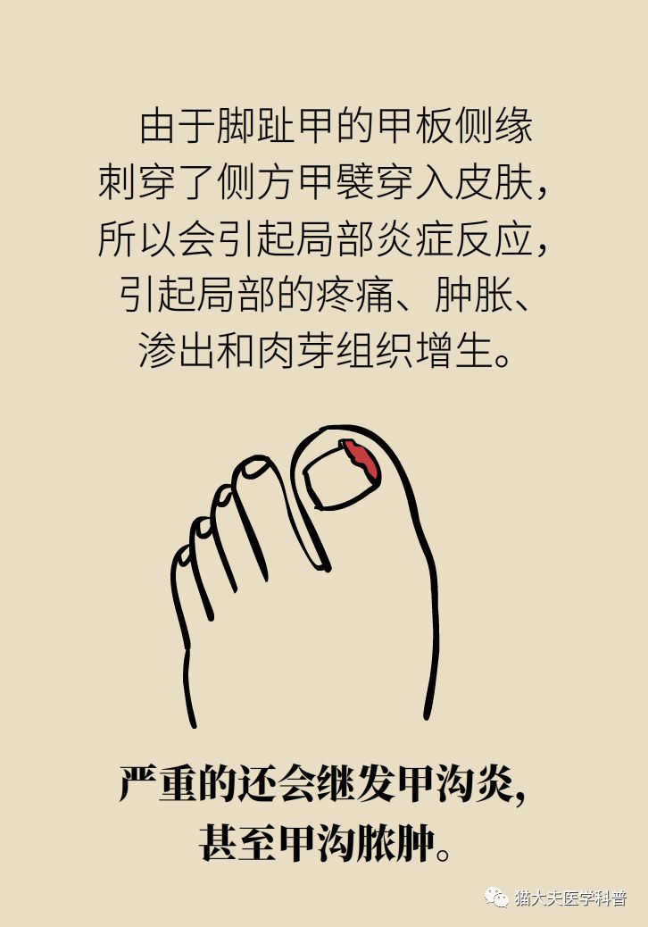 脚趾甲往肉里长怎么治除根,脚趾甲长在肉里面治疗视频