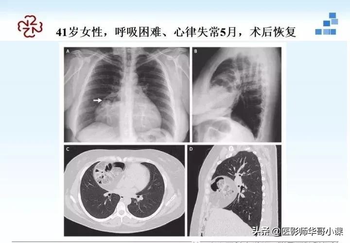 「精品课件」胸部膈肌的解剖及常见病变影像的表现