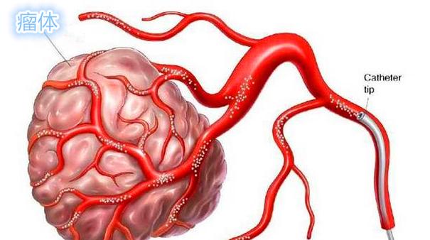 子宫肌瘤介入栓塞造影剂作用,子宫肌瘤介入栓塞有副作用吗