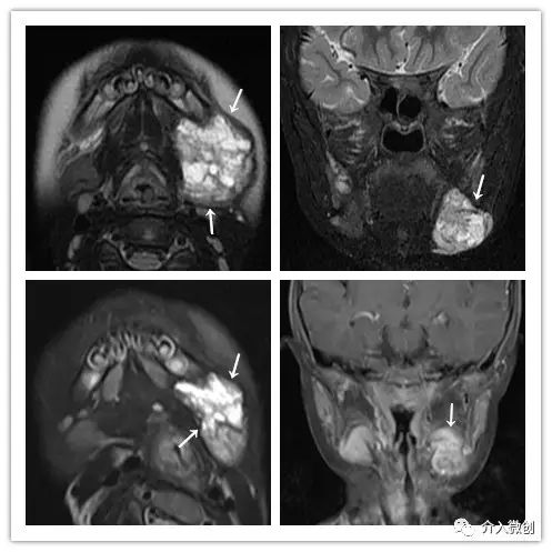淋巴管畸形硬化治疗费用,静脉畸形硬化的最佳治疗方法