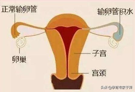 青岛助孕专家于萍：输卵管积水怎么办？还能怀孕吗？