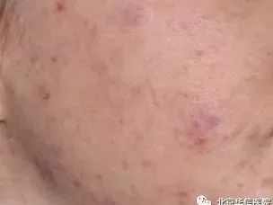 光子嫩肤帮你逆袭光滑细嫩状态,光子嫩肤让你拥有蛋壳般肌肤