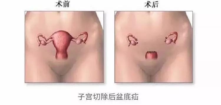 生娃对子宫伤害大还是引产伤害大,生娃对女人的伤害