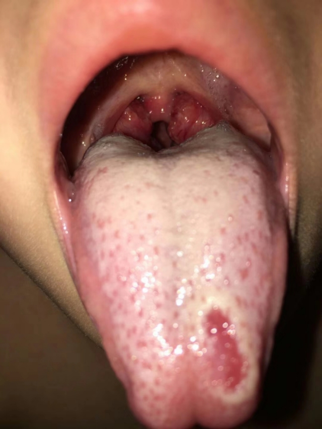 中医临床治疗扁桃体发炎医案,化脓性扁桃体炎中医辨证论治