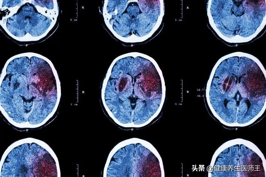 脑出血生命之缘,生命缘脑出血纪录片