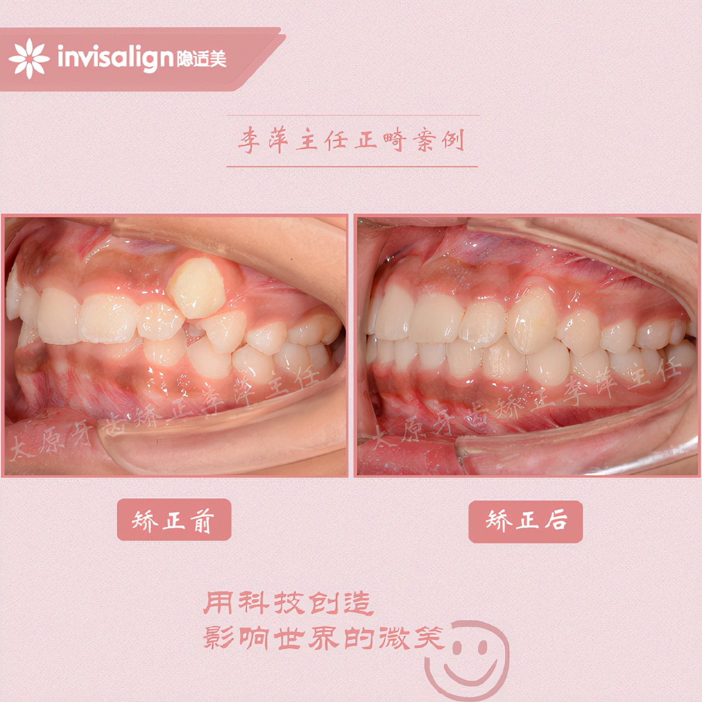 山西太原牙齿矫正医院十大排名,太原市牙齿矫正成功案