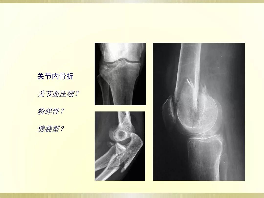骨科x光片读片技巧,放射科骨科读片教程
