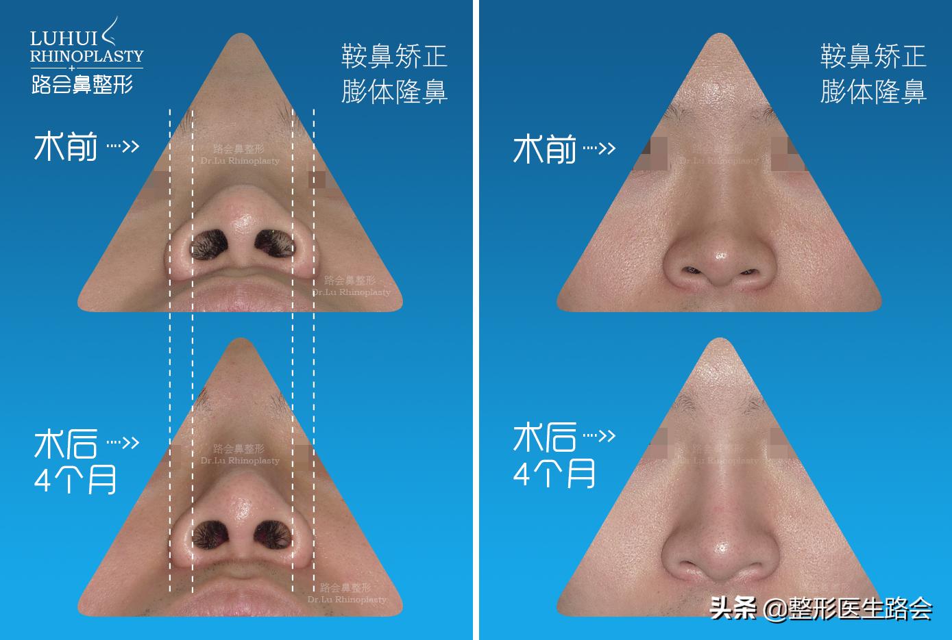 鼻翼缩小后期鼻头变宽,鼻翼变宽鼻头变大怎么改善