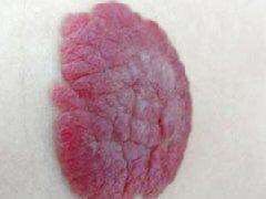 什么是损容性皮肤,损容性皮肤病名词解释