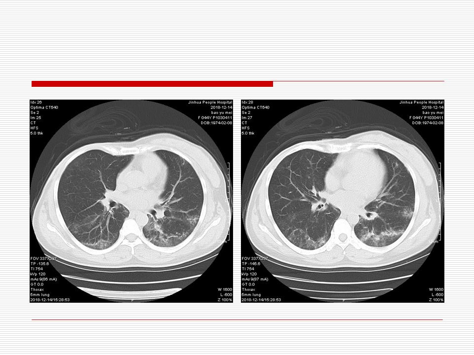 像炎症的肺癌能治好吗,医生说可能是肺癌也可能是炎症