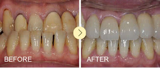 四环素牙治疗方法哪种效果好,四环素牙是树脂好还是陶瓷好