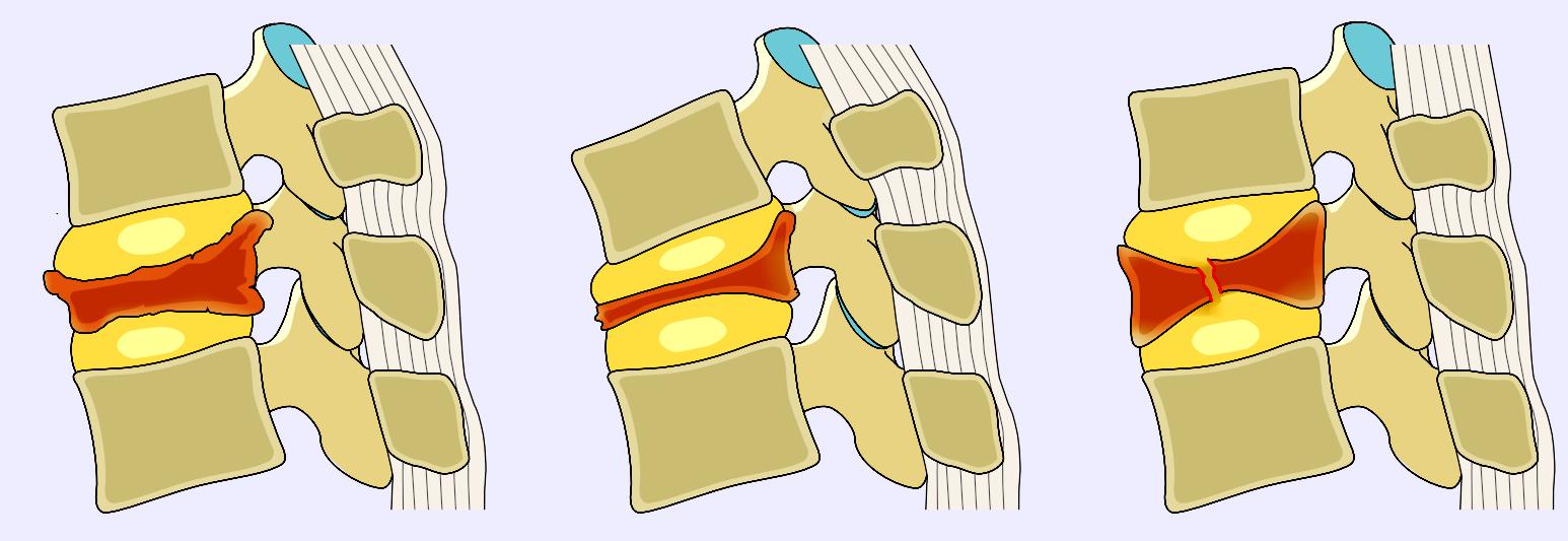 骨质疏松椎体压缩性骨折治疗指南,德国骨科骨质疏松骨折
