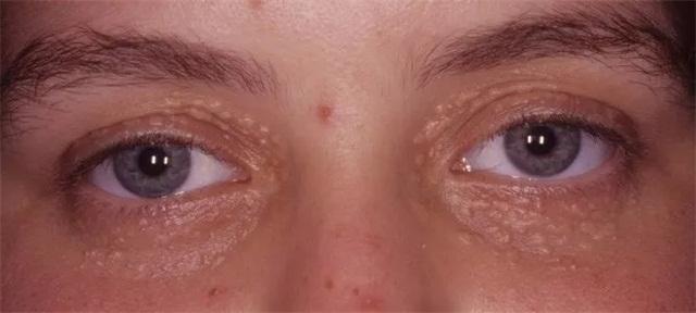 脸上频繁长脂肪粒怎么办,脸上长脂肪粒怎么办有效