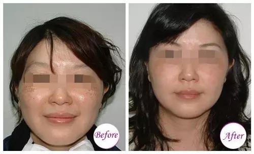 755激光祛斑和其他激光有什么区别,祛斑后反黑后可以再次激光祛斑吗