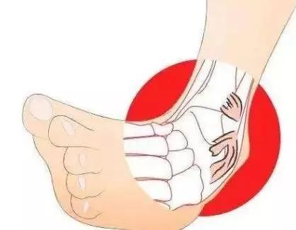 运动踝关节扭伤,踝关节扭伤崴脚